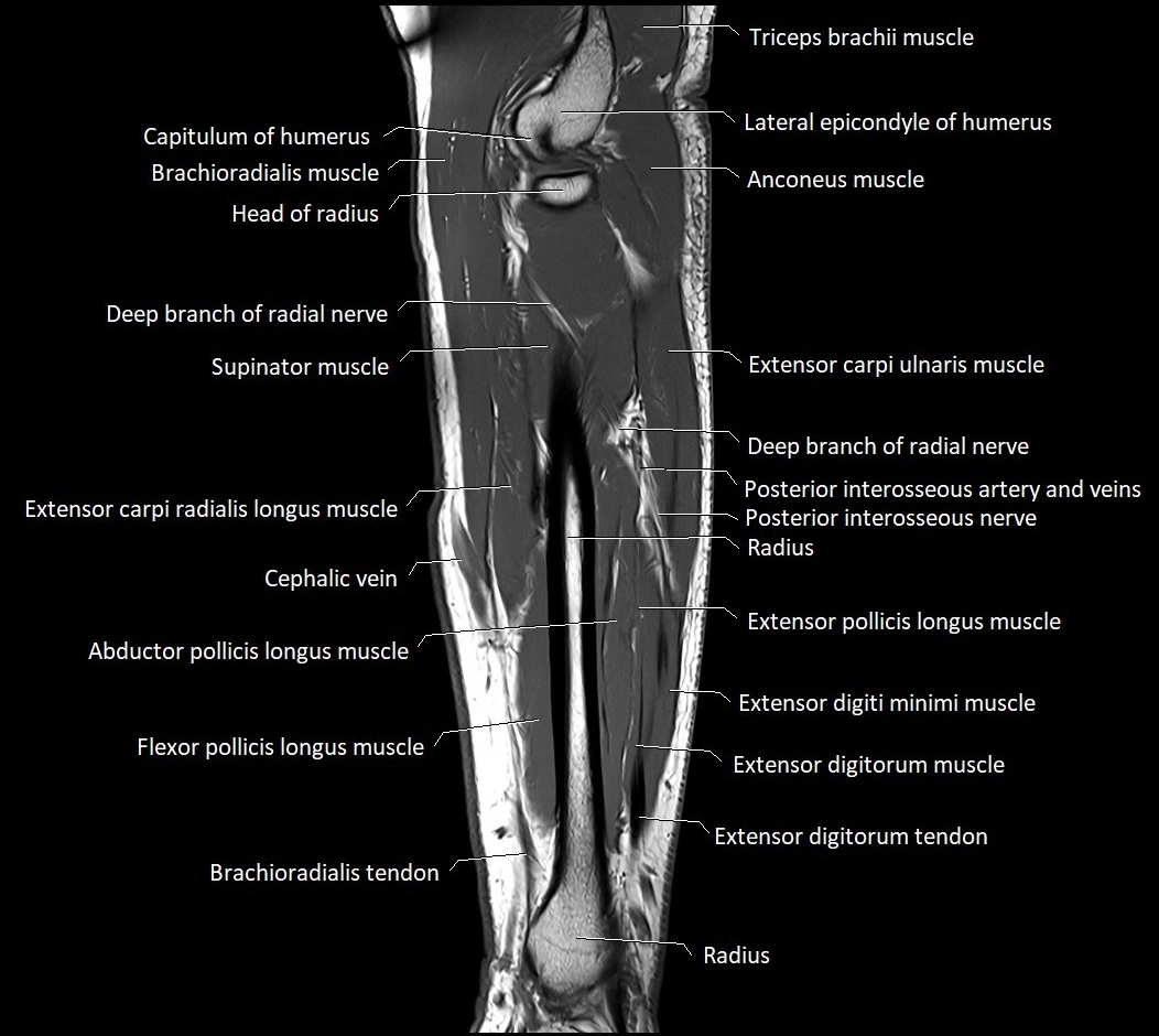 MRI 3T forearm sagittal labelled cross sectional anatomy image 15.webp